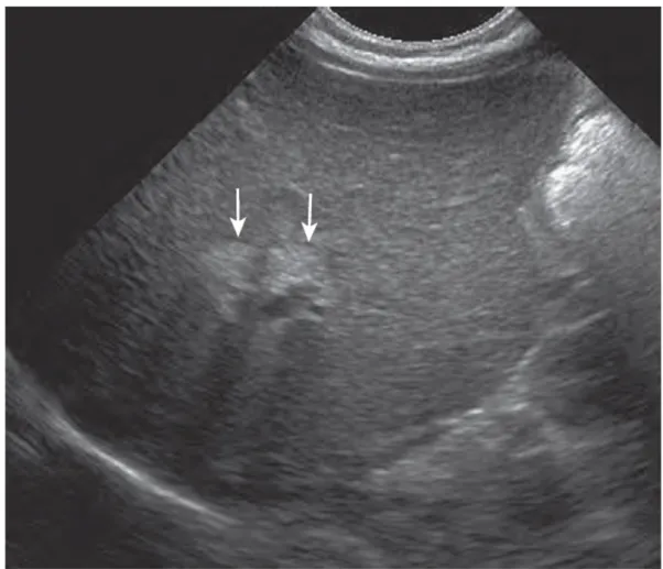 Gambar   2.3   Atresia   bilier:  Triangular   cord   sign  pada   ultrasound.   Tanda triangular cord  menggambarkan duktus koledokus yang terobliterasi pada bayi dengan atresia bilier