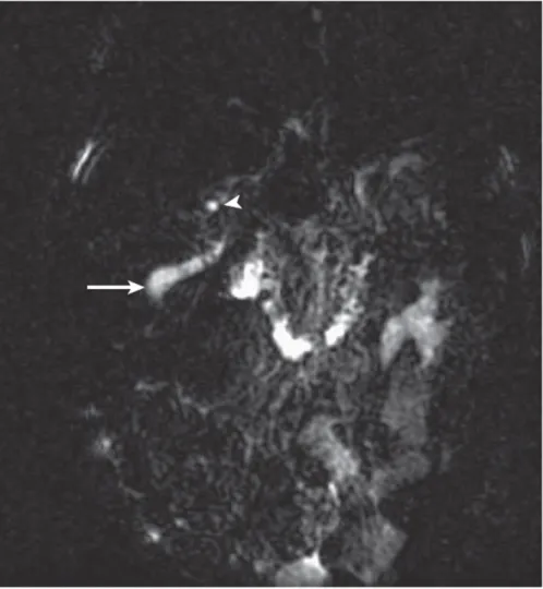 Gambar 2.6 Atresia bilier: temuan gambar pada MRCP. Irisan coronal, T2- T2-weighted.   Pada   bayi   berusia   19   hari   degnan   cholestasis   tampak   gambaran peningkatan intensitas (kepala panah) pada porta hepatis yang menunjukkan lesi kistik pada p