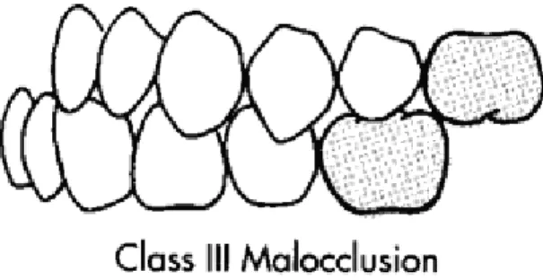 Gambar 3 : Maloklusi Klas III 