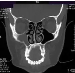 Gambar 4.  Coronal view demonstrating opacified left maxillary sinus.