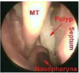 Gambar 9.  Polip Nasi