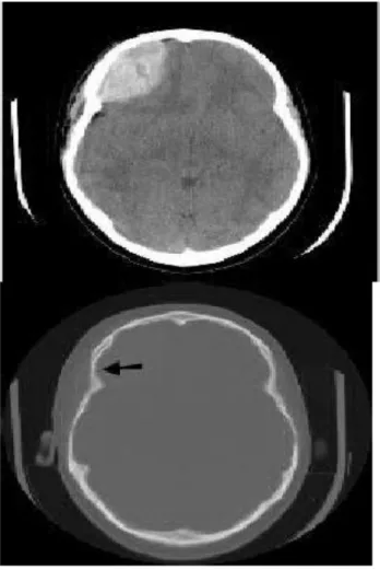 Gambar 1. Gambaran CT-Scan Hematoma Epidural di Lobus Fronal  kanan.(Di kutip dari kepustakaan 9) 