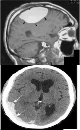 Gambar 3. Gambaran MRI Hematoma Epidural.(Di kutip dari kepustakaan  4)