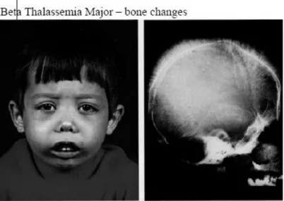 Gambar   6.   Deformitas   tulang   pada   thalassemia   beta   mayor   (Facies  Cooley)