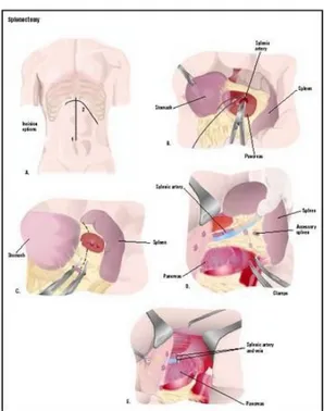 Gambar 8. Splenektomi