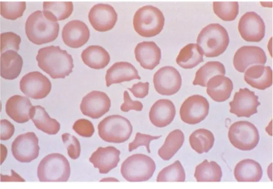 Gambar 1. Sapuan apus darah tepi Penyakit Hb H pada neonatus