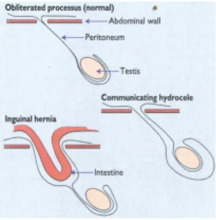 Gambar 2. Patogenesis Hidrokel