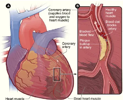 Gambar  1  Myocardial  infarction:  (A)  jantung  yang  mengalami  kerusakan  cardiomyocyte  dan  (B)  penyempitan  pembuluh  darah  arteri  yang  menyebabkan kerusakan cardiomyocyte  (NHLBI 2008)