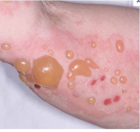 Gambar 10. Impetigo neonatorum Sumber: http://classconnection.s3.amazonaws.com