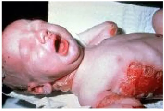 Gambar 5. Bayi dengan EBJ subtipe Herlitz