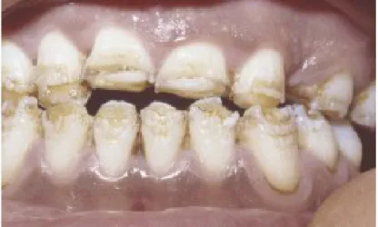 Gambar 6. Gigi pasien dengan EBJ Generalized non-Herlitz Sumber: http://emedicine.medscape.com/article/1062939-clinical#a0217