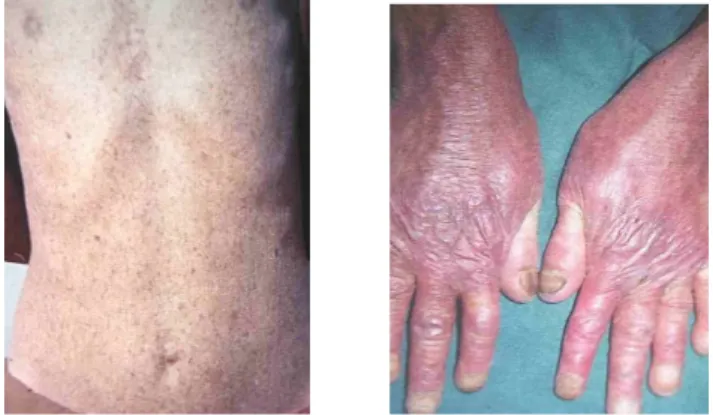 Gambar 8. Sindrom Kindler dengan poikiloderma (kiri) dan bula (kanan) Sumber:  http://www.orpha.net/data/patho/GB/uk-kindler.pdf