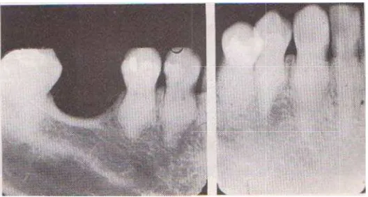 Gambar 14. AAdanya pulp sttone pada gigi molar.8,17 