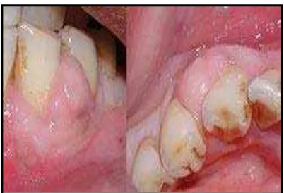 Gambar 1. Abses gingiva (http://medical- dictionary.thefreedictionarycom    /gingival + abscess) 