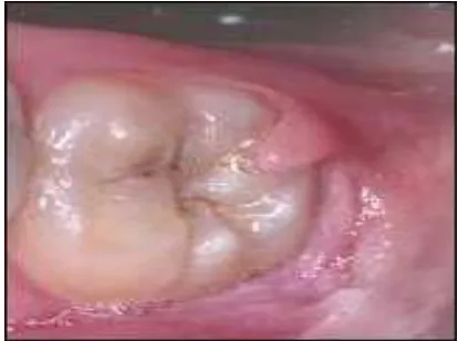 Gambar 4. Abses perikoronal ( http://www.        nycdentist.com/dental-photodetail        /569/213/212/dental-teeth-abscess-                        infection-tooth) 