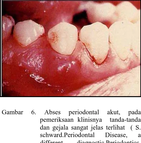 Gambar 5. Abses periodontal akut (http://www.                             dent. ucla.edu /pic/members/ antibiot                                    ics /abscess/abscess.html) 