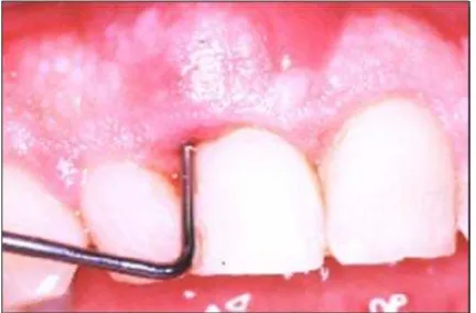 Gambar  7. Abses periodontal kronis (http://www.                                dent.ucla.edu/pic/members/antibiotics                   /abscess/abscess.html )  