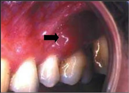 Gambar 10: abses periodontal akut pada gingiva bagian bukal dari gigi molar satu maksila ( Keys