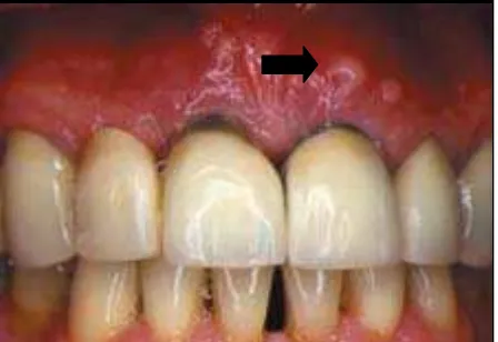 Gambar 11. Abses peridodontal kronis pada       bagian labial gingiva dari gigi insisivus (Keys.David captain