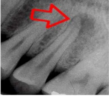 Gambar 12.Gambaran radiografi abses periodontal(http://balsandira.blogspot.com /2009/03/ 