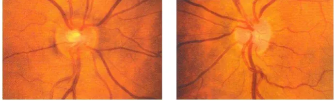 Gambar 2. Asymmetry of optic nerve cupping. Note the generalized enlargement of the cup inthe right eye (A) as compared with the left eye (B).Asymetry of the cup-disc ratio of more than 0,2 occurs in less than 1% of normal individuals