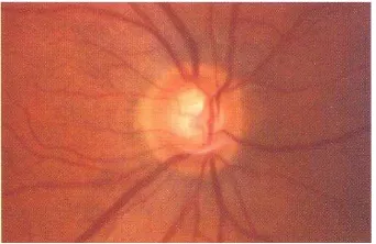 Gambar 3. Splinter hemorrhage (arrow) of the right optic nerve at the 7 