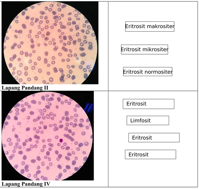 Gambar Keterangan Kode preparat : 460Limfosit Eritrosit Eritrosit Eritrosit makrositer