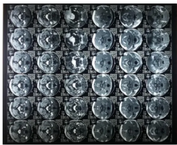 Gambar 1. CT-Scan Kepala 