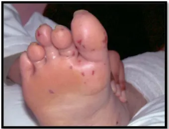 Gambar 2.1 Ptechiae pada pasien IE 2