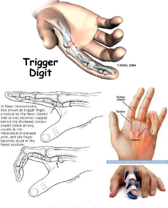 Gambar 5. Trigger Finger C. Epidemiologi