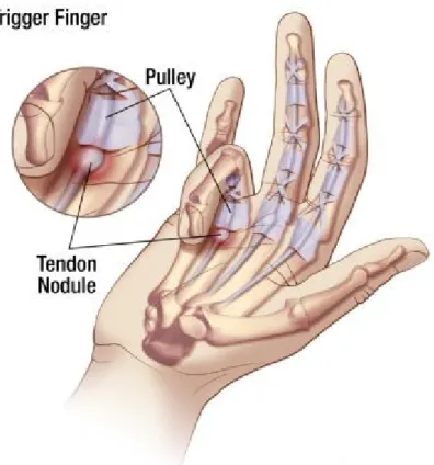Gambar 6. Trigger Finger