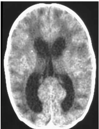 Gambar 2.  Ventrikulomegali pada   infeksi CMV kongenital. 