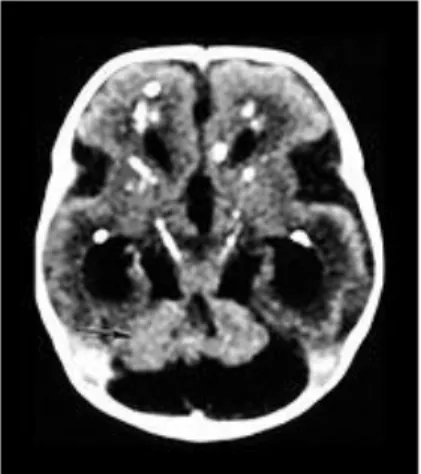 Gambar 3.  Hipoplasi cerebellum sebagai  manifestasi atrofi cerebri    pada  infeksi CMV kongenital