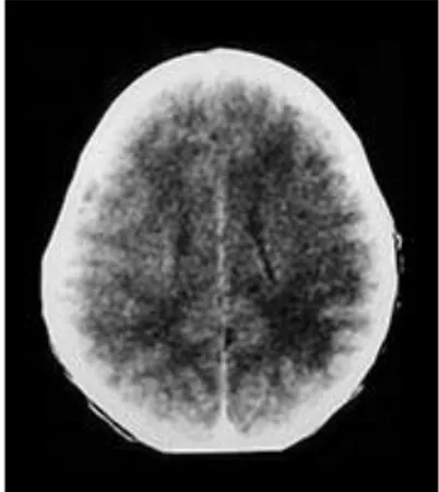 Gambar 6.   Edema otak ringan pada   pasien infeks Herpes Simplex. 