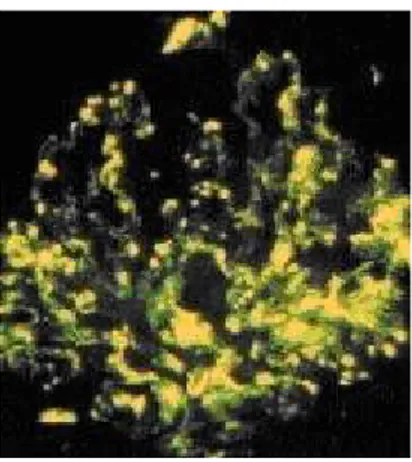gambar diambil dengan menggunakan mikroskop electron. Gambar menunjukjan proliferadi dari sel endothel dan sel mesangial juga infiltrasi lekosit yang bergabung dnegan deposit electron di subephitelia.(lihat tanda panah)