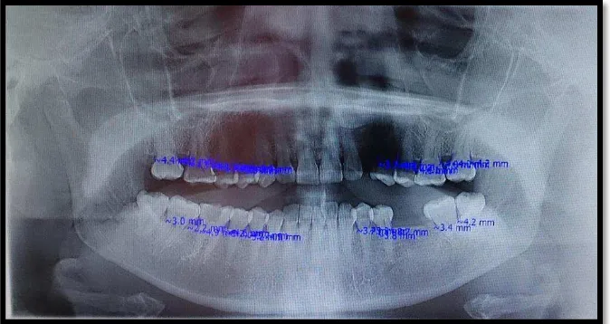 Gambar 3.1. Radiografi panoramik dan pengukuran kehilangan tulang alveolar pada subjek peneltian