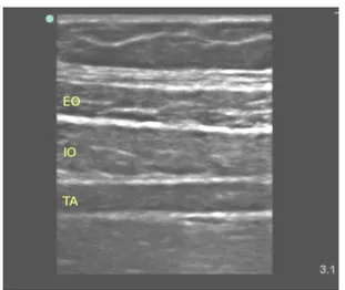 Gambar 2.9 Gambaran ultrasonografi dinding abdomen. EO: external oblique, IO: 