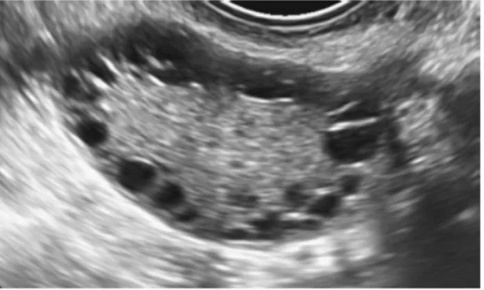 Gambar 2.3. Gambaran Ovarium Polikistik pada ultrasonografi. 19  Dewaily dkk (2010) menemukan bahwa gambaran ovarium polikistik  sendiri merupakan tanda dari hiperandrogenisme
