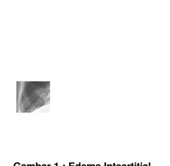 Foto thoraks Pulmonary edema secara khas didiagnosa dengan X-ray dada. Radiograph (X- (X-ray) dada yang normal terdiri dari area putih terpusat yang menyinggung jantung dan