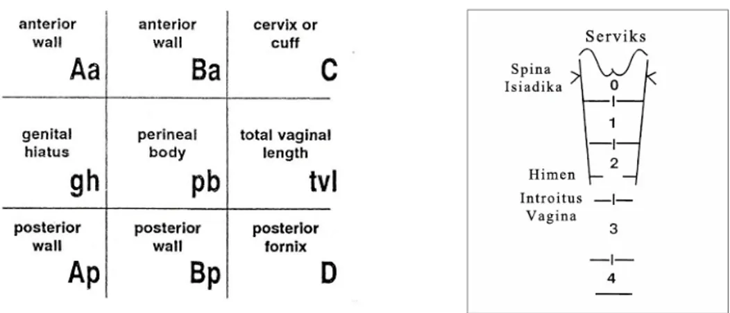 Gambar 1. Tabel 3x3 deskripsi pencatatan kuantitatif dukungan organ  pelvis (kiri) dan gambaran sistem klasifikasi Baden-Walker (kanan) 