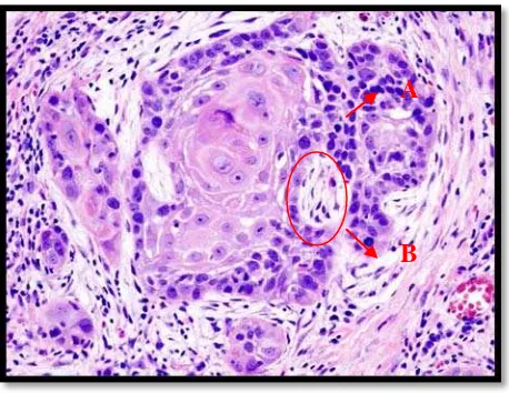 Gambar 1. Gambaran histopatologi KSS berdiferensiasi baik dengan pewarnaan Hematoksilin Eosin (HE) A