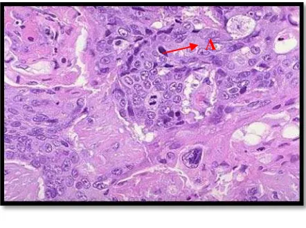Gambar 3.  Gambaran Histopatologi KSS berdiferensiasi buruk dengan pewarnaan HE. A. Inti sel