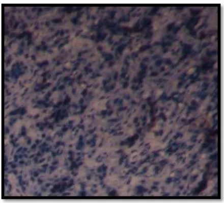 Gambar 1. Kontrol positif (kontrol internal) hasil pewarnaan imunohistokia Lmp-1 pada KSS rongga mulut  dengan tampilan warna coklat paling kuat pada membran (A).inti sel tumor pembesaran 40x (dokumentasi)