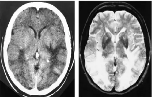 Gambar 2.1 Gambaran  CT Scan  (kanan) dan  MRI  (kiri) kepala pada wanita 55  tahun dengan Ensefalopati Hipertensi dan   kejang menunjukkan adanya lesi white  matter  yang terkonsentrasi pada bagian posterior otak