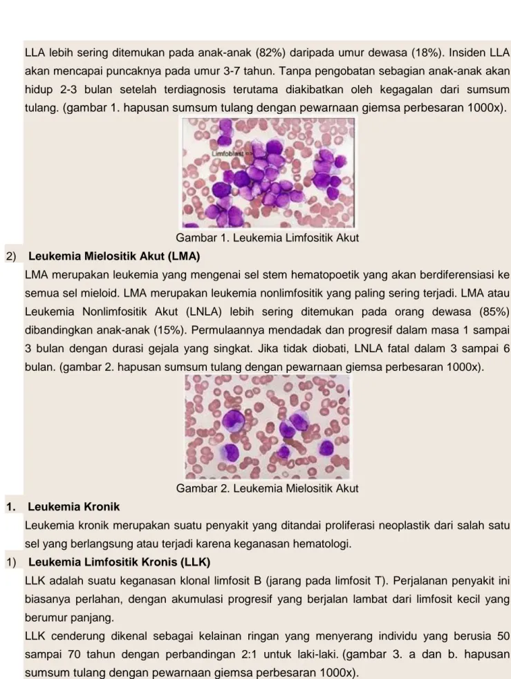 Gambar 1. Leukemia Limfositik Akut 