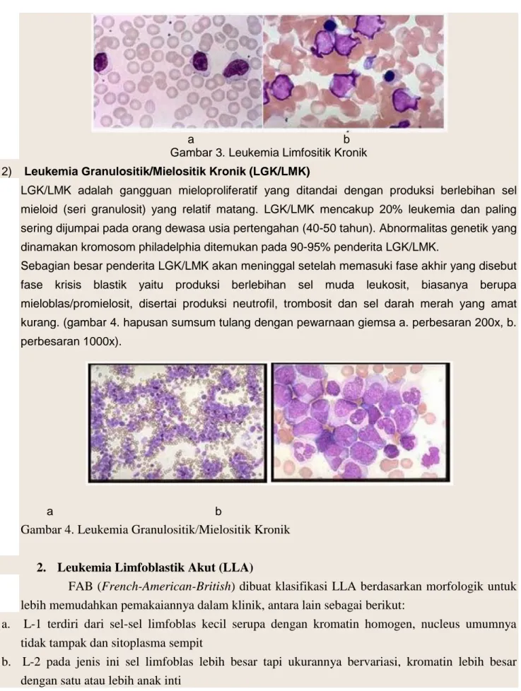 Gambar 4. Leukemia Granulositik/Mielositik Kronik