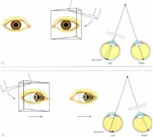 Gambar  5.    4∆  prism  test  pada  mikrotropia  mata  kiri  dengan  skotoma  supresi  sentral