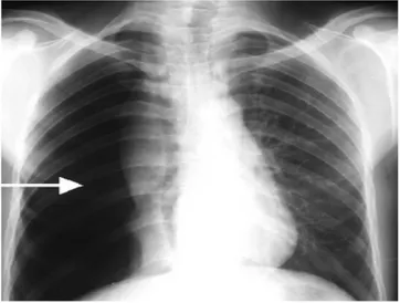 Gambar 3. foto Pneumothorax dengan bayangan  udara dalam cavum pleura memberikan  bayangan radiolusen yang tanpa struktur jaringan paru (avascular pattern) (11)