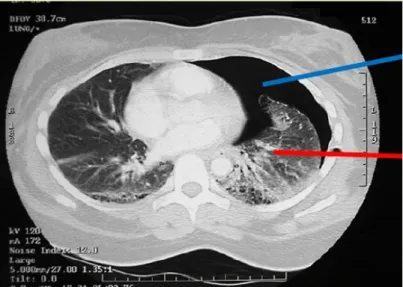 Gambar 7. Pneumothorax ct scan  potongan axial Tampak udara dan colaps paru (12) . 