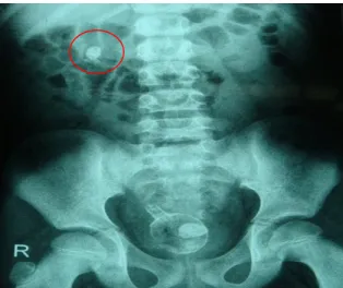 Foto  polos  abdomen  ini    bertujuan  untuk  melihat  kemungkinan  adanya  batu   radio-opak  di  saluran    kemih